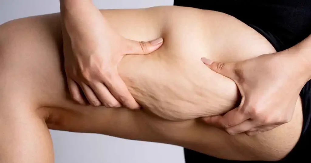 How to Lose Weight Without Getting Loose Skin